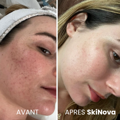 Stylo DermaRepair SkiNova™